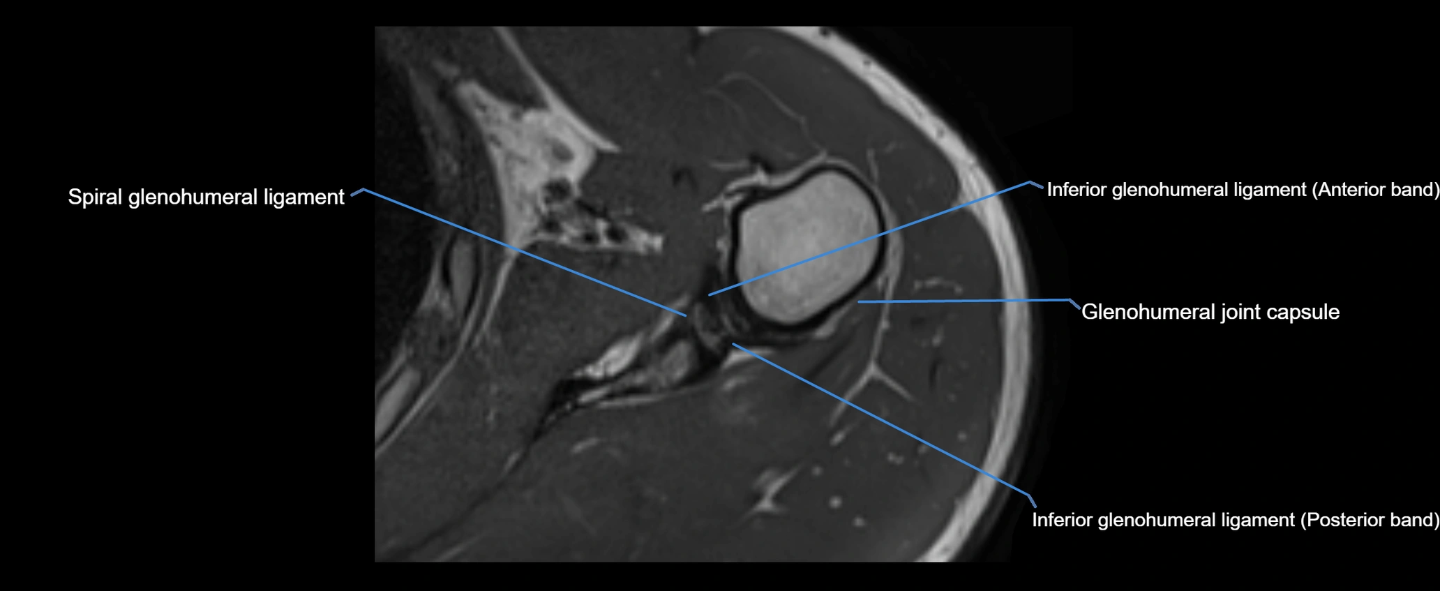 shoulder ligaments axial 3d 3t mri image-img-00005-00085.webp